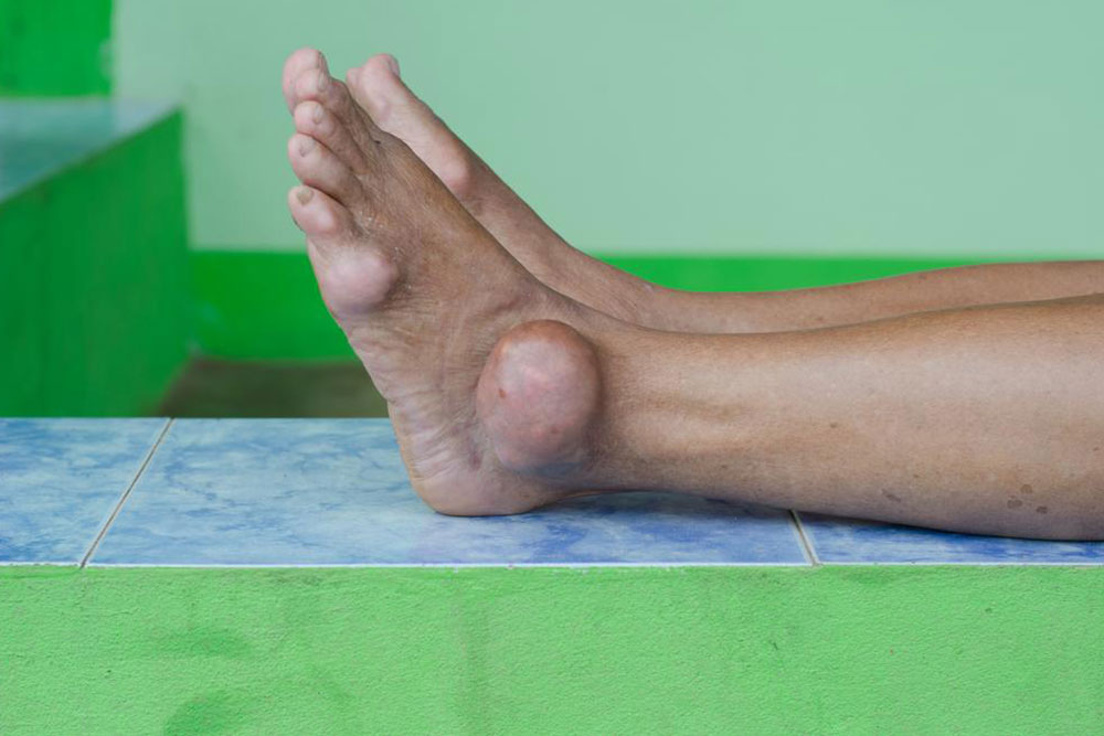 Gout attacks and their treatment procedures