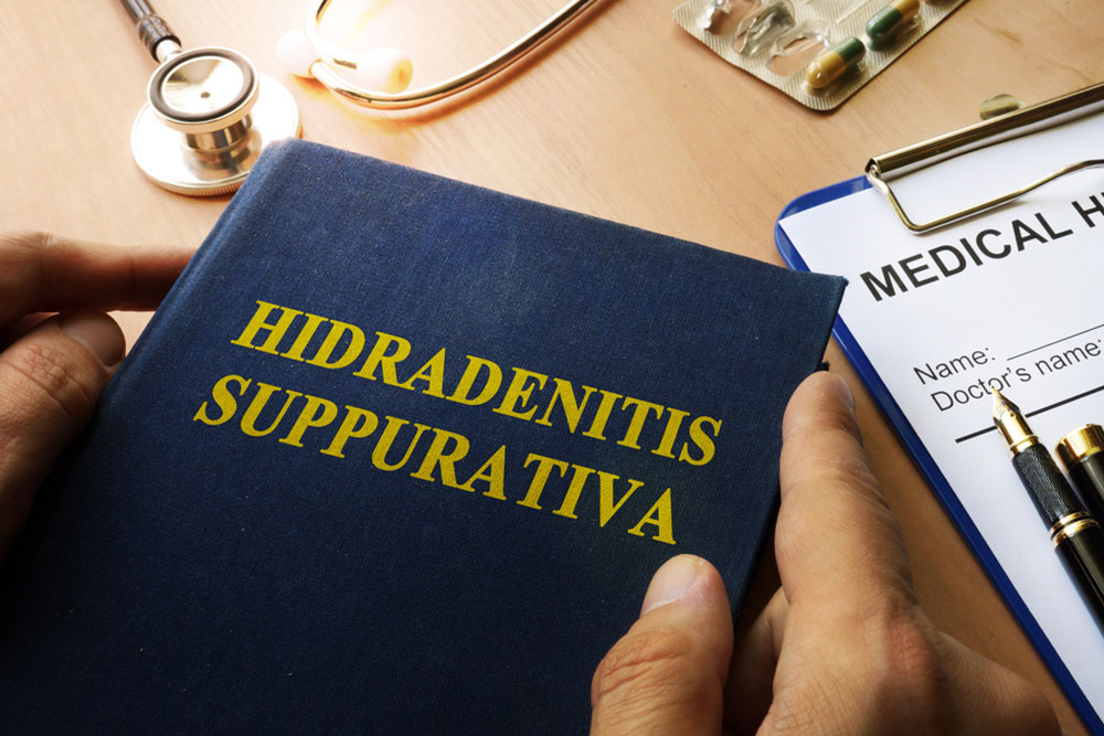 All You Need to Know about Hidradenitis Suppurativa