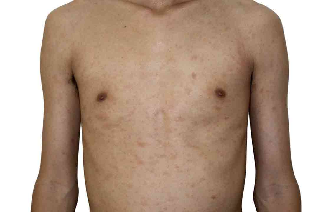 Different Types of Pityriasis Rosea Treatments