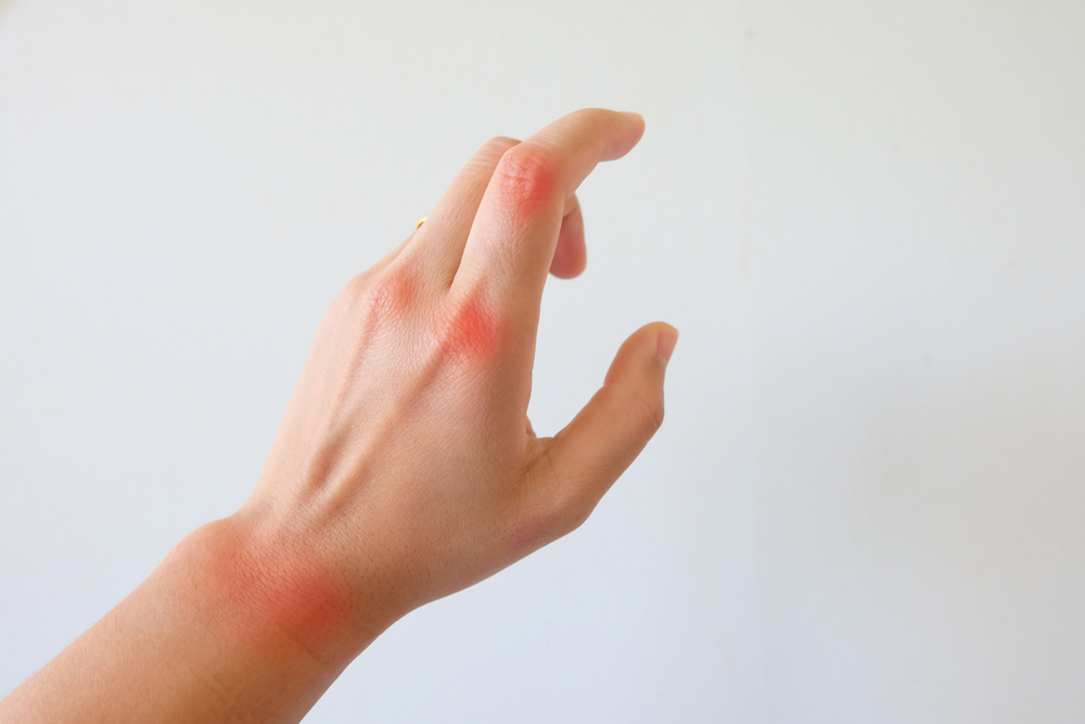 Here’s How You Should Deal With Psoriatic Arthritis