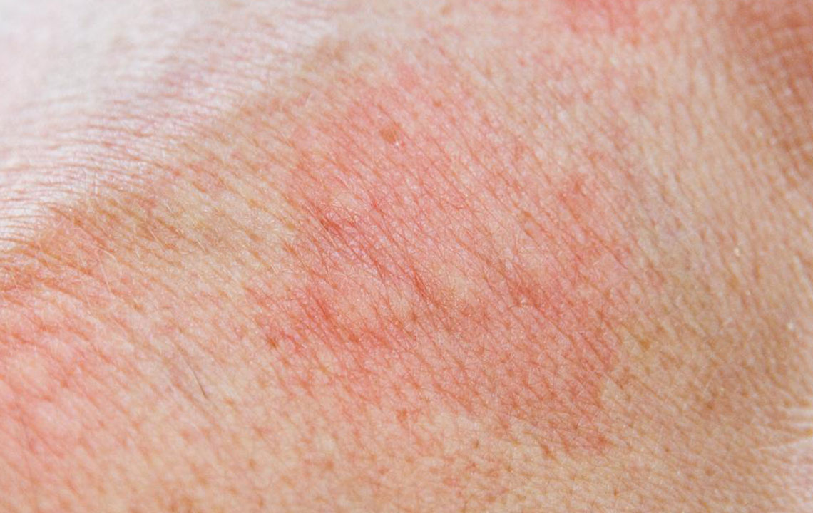 Know about the 5 Types of Skin Rashes