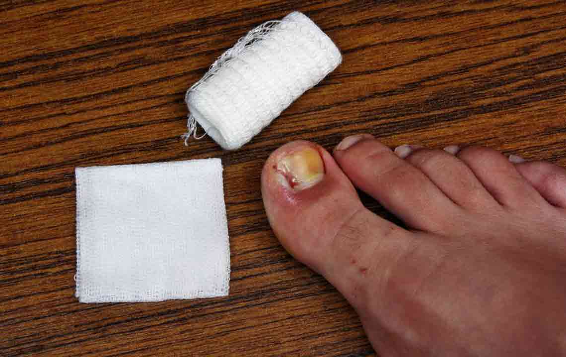 Popular Ways to Treat Toenail Fungus