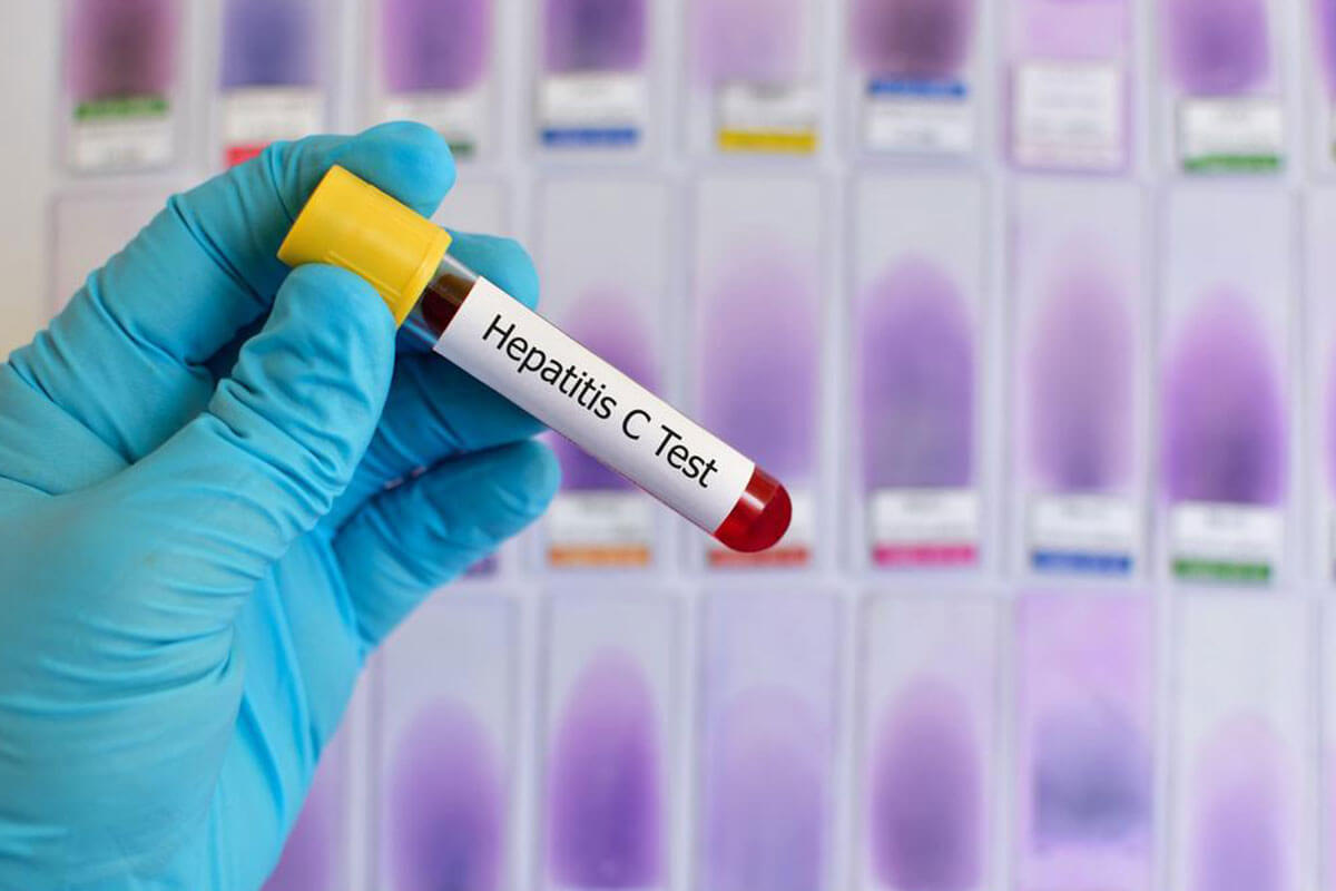 What to Expect from Hepatitis C Treatment