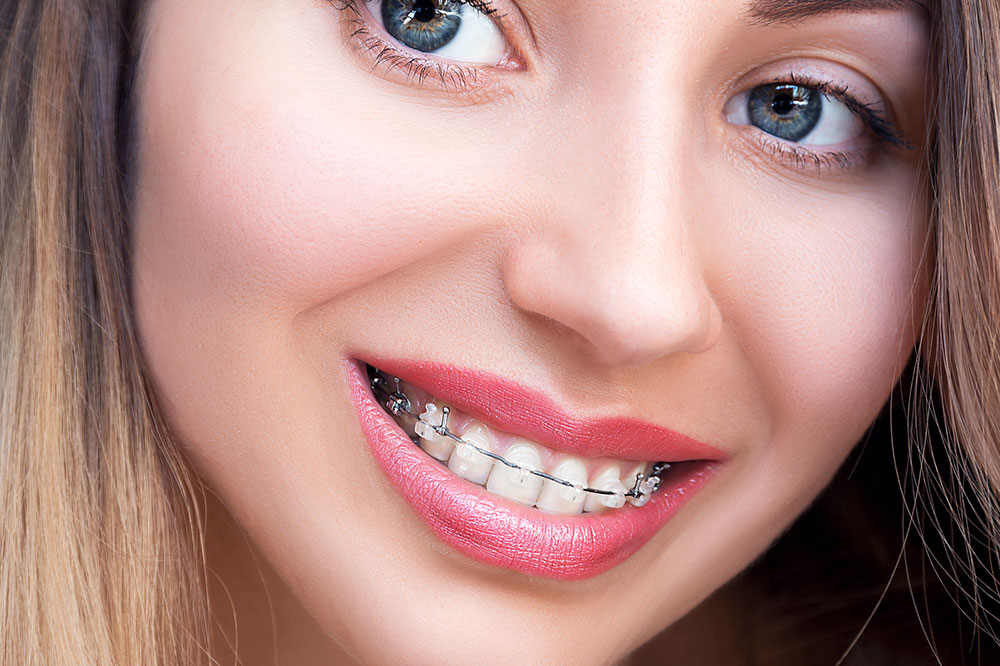 5 things you should know before you get braces